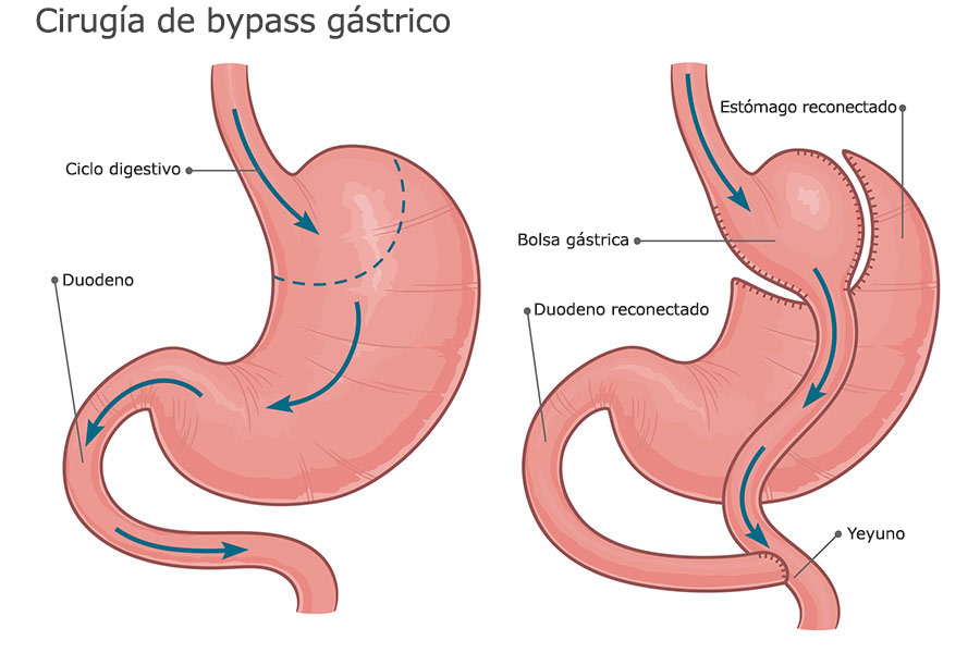 gráfico cirugía de bypass gástrico