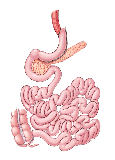 ilustración de la manga gástrica