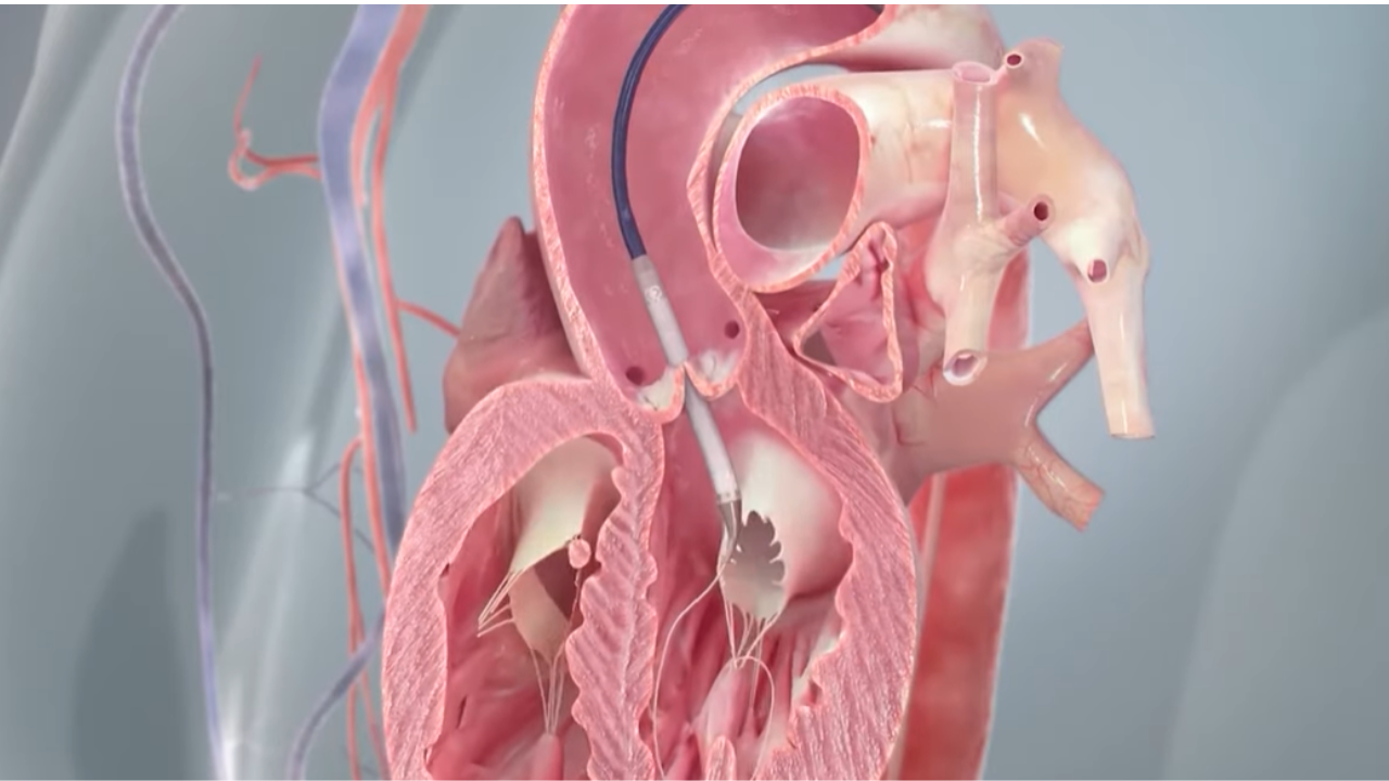 Tratamiento de la estenosis aórtica con TAVR