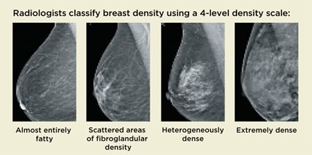 Escala de densidad mamaria de 4 niveles
