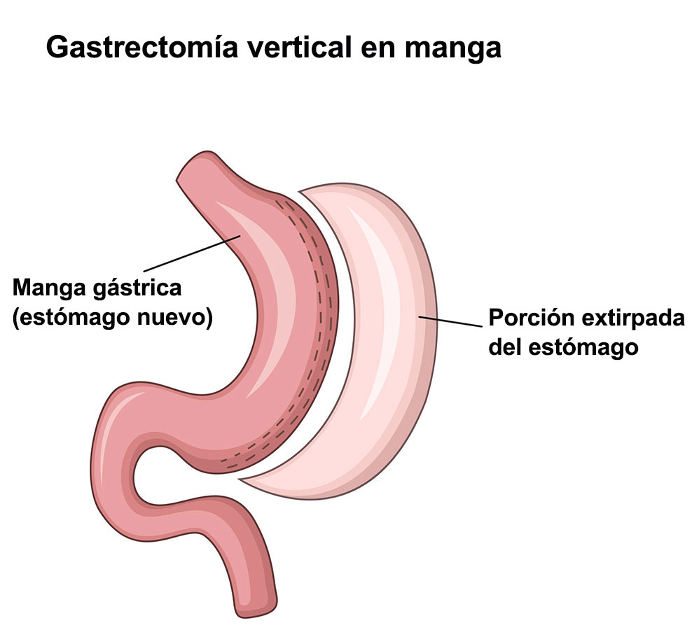gráfico de la gastrectomía en manga