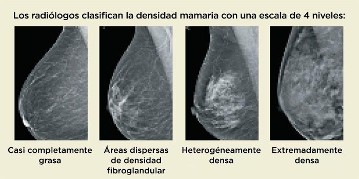 Escala de densidad mamaria de 4 niveles