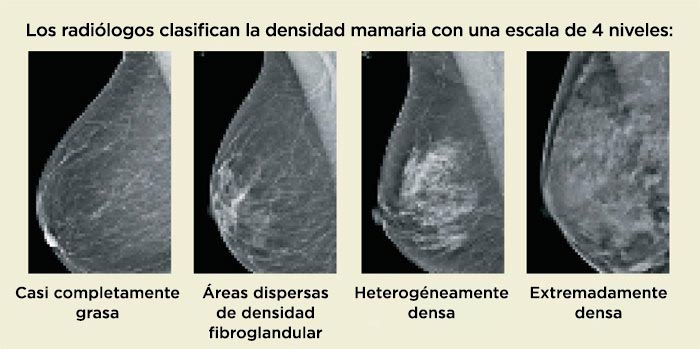 Escala de densidad mamaria de 4 niveles